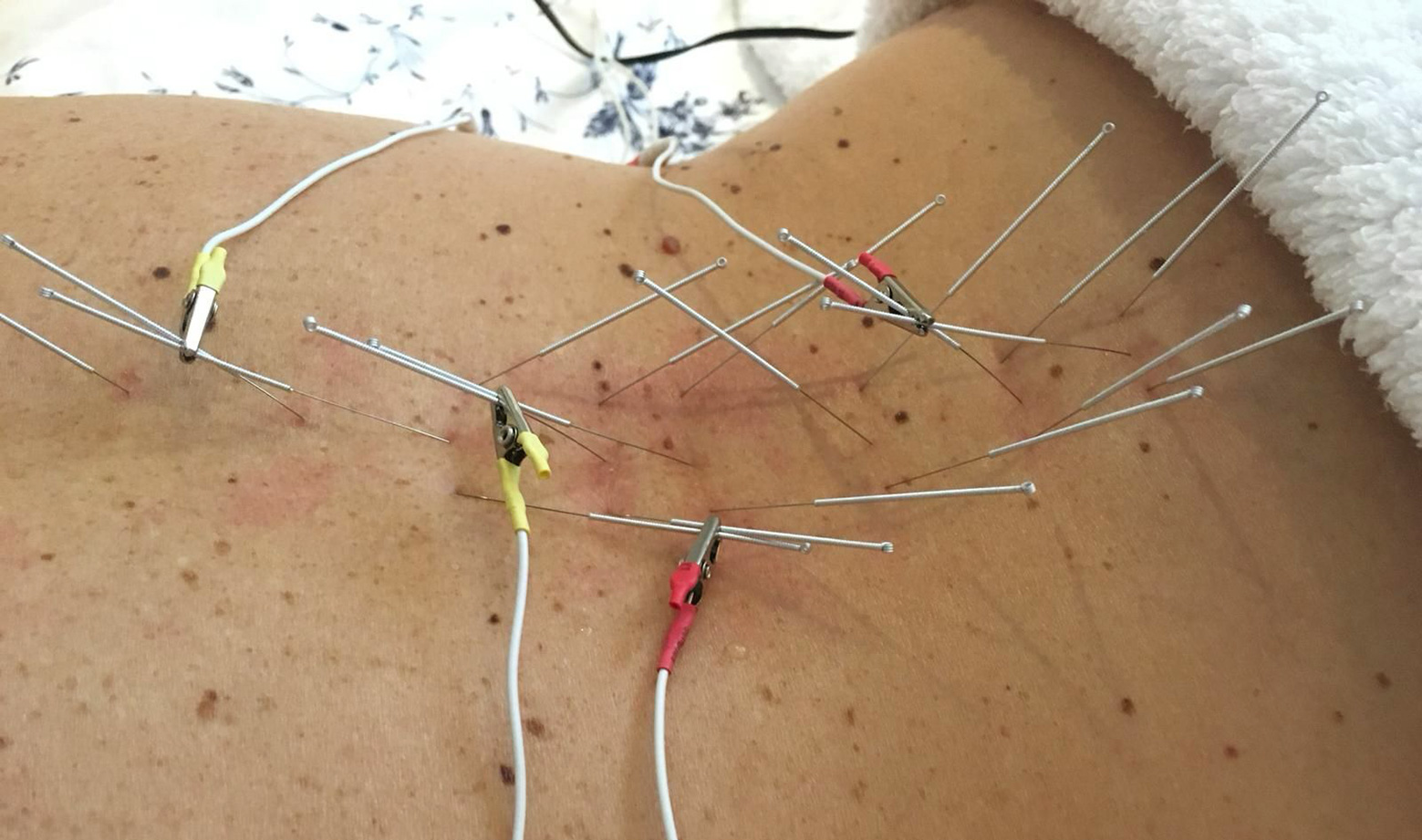 On World Spine Day, we look at how electro acupuncture can help to ease pain