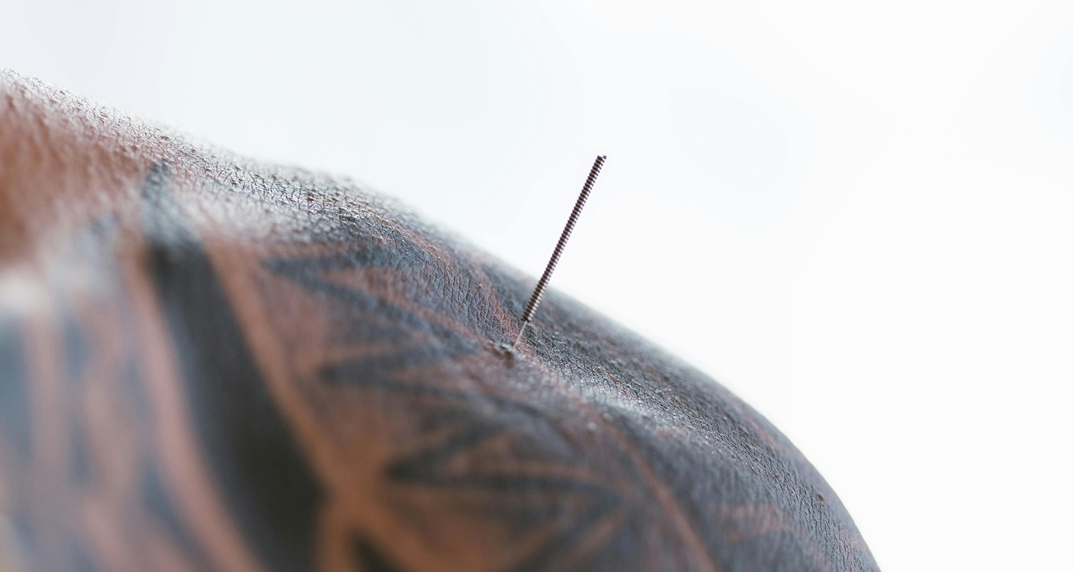 Acupuncture is one of the cornerstone elements of TCM