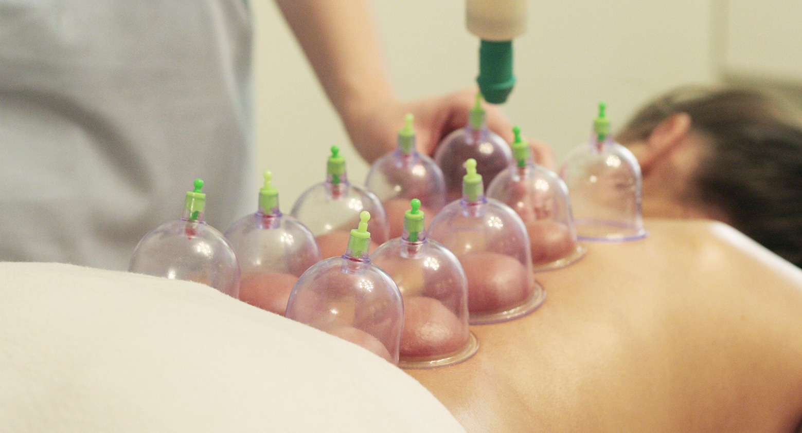 Professional Cupping Therapy Courses are available at Touch Tuina