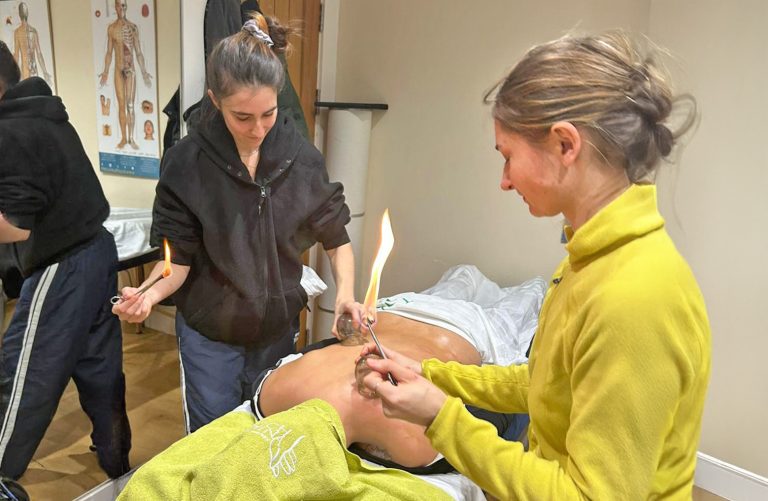 Cupping being demonstrated at Touch Tuina London